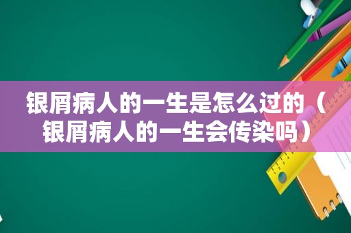 银屑病人的一生是怎么过的（银屑病人的一生会传染吗）